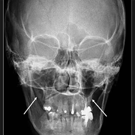X-ray Skull Townes View Procedure